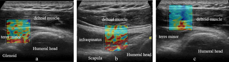 Effect of extension on stiffness of the teres minor muscle following extracorporeal shock wave therapy for frozen shoulder: a double-blind, randomized, controlled trial.