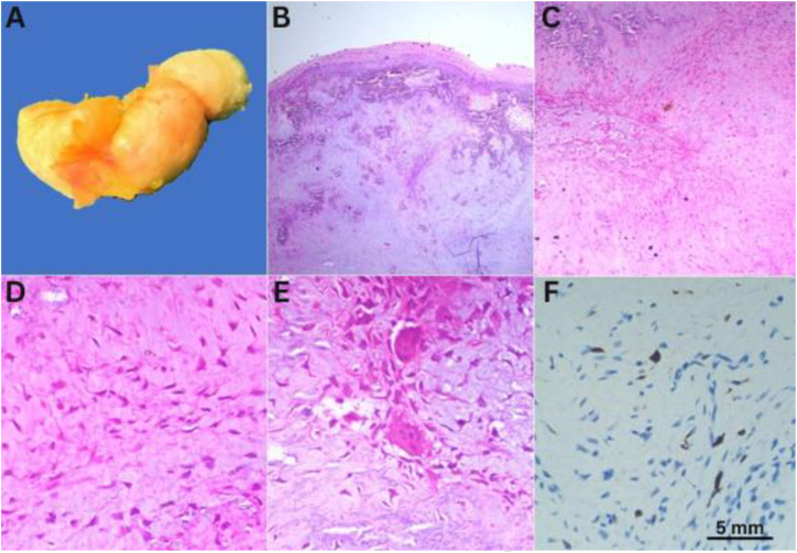 Chondromyxoid Fibroma of Phalanges.