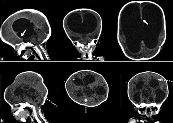 Expression of Human Myxovirus Resistance Protein 1 (MxA) in Shunt Infections.