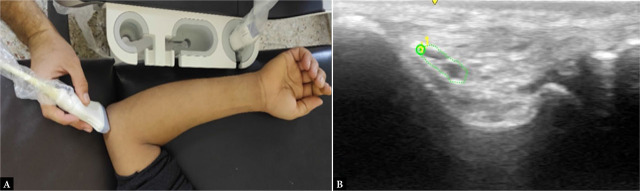 Point-of-care ultrasound: a viable alternative for assessing ulnar neuropathy in rheumatoid arthritis?