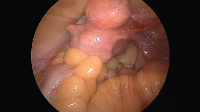 The initial experience of natural orifice specimen extraction surgery in laparoscopic colorectal surgery.