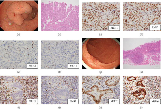 Clinicopathological and Genetic Features in Superficial Nonampullary Duodenal Epithelial Tumors.