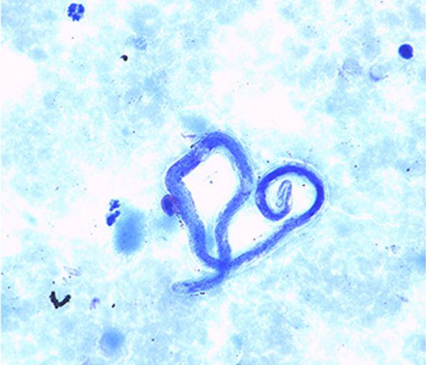 Treatment of loiasis: a review of clinical management recommendations.