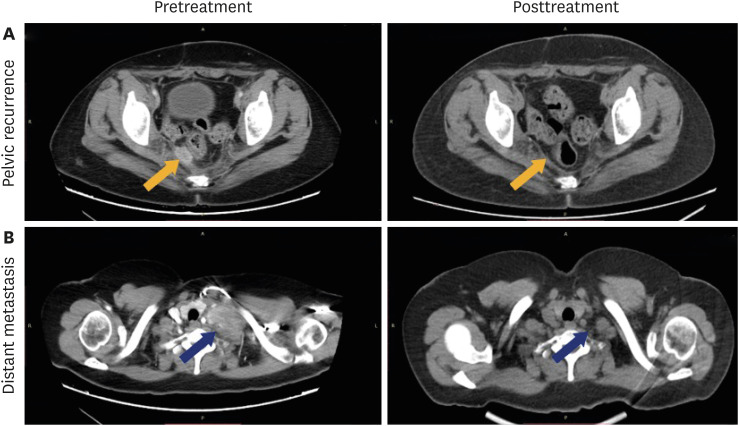 Toripalimab combined with bevacizumab plus chemotherapy as first-line treatment for refractory recurrent or metastatic cervical cancer: a single-arm, open-label, phase II study (JS001-ISS-CO214).