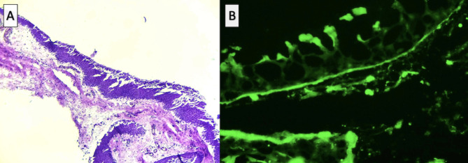 Childhood-onset ocular mucous membrane pemphigoid presenting with peripheral ulcerative keratitis: a case report and review of the literature.