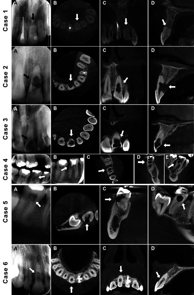 The influence of cone-beam computed tomography and endodontic practitioners' proficiency level on diagnosis and treatment planning of root resorption.