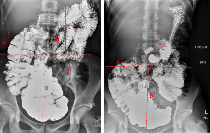 Radiographic Identification of Visceroptosis in Patients With Hypermobile Ehlers-Danlos Syndrome With Functional Gastrointestinal Symptoms Compared With Healthy Subjects.