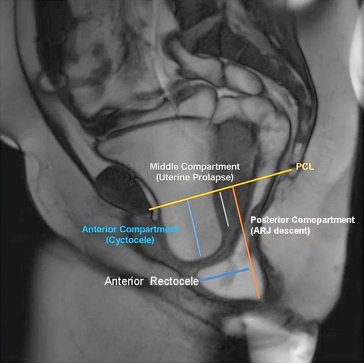 Magnetic resonance defecography assessment of obstructed defecation syndrome in patients with chronic constipation in a tertiary care hospital.