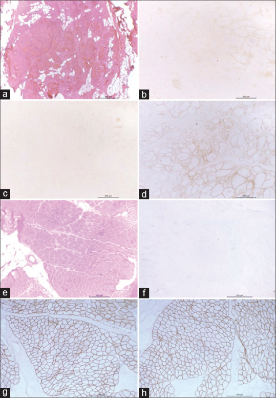 A Clinical Study on the Utility of Muscle Biopsy in Patients with Suspected Myopathy.