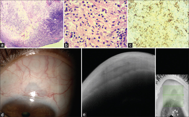 Rosai-Dorfman disease presenting as a scleral nodule in a female with multisystem inflammatory syndrome post-COVID-19 infection.