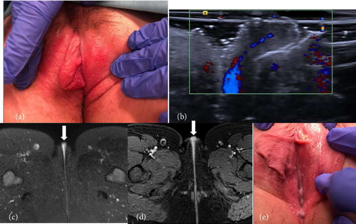 Adolescents With Labial Enlargement Misdiagnosed as Labial Masses on Imaging.