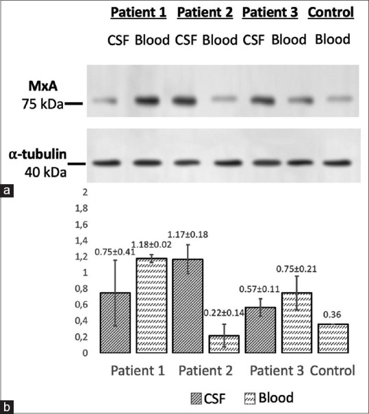 Expression of Human Myxovirus Resistance Protein 1 (MxA) in Shunt Infections.