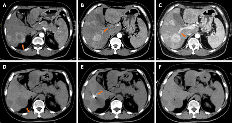 Computed tomography-guided percutaneous biopsy for assessing tumor heterogeneity in neuroendocrine tumor metastases to the liver.