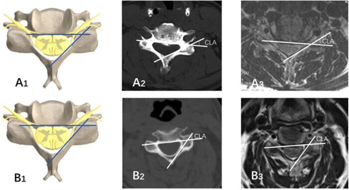 Cord-lamina angle and foraminal diameter as key predictors of C5 palsy after anterior cervical decompression and fusion surgery.