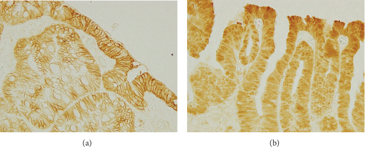 Clinicopathological and Genetic Features in Superficial Nonampullary Duodenal Epithelial Tumors.