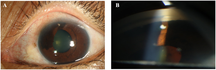 A case report: iridociliary melanocytoma associated with secondary glaucoma.