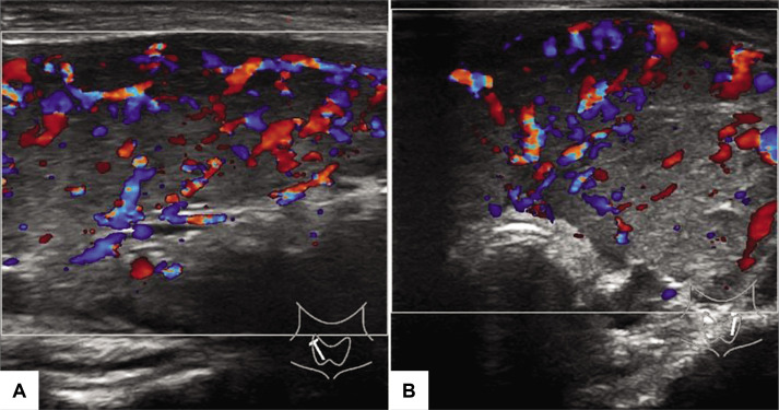 Oscillation between Hyperthyroidism and Hypothyroidism in an Adolescent Female with Graves' Disease.