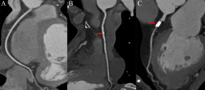 Prognostic value of non-obstructive coronary artery disease based on coronary computed tomography angiography in a long-term follow-up and multicenter study.