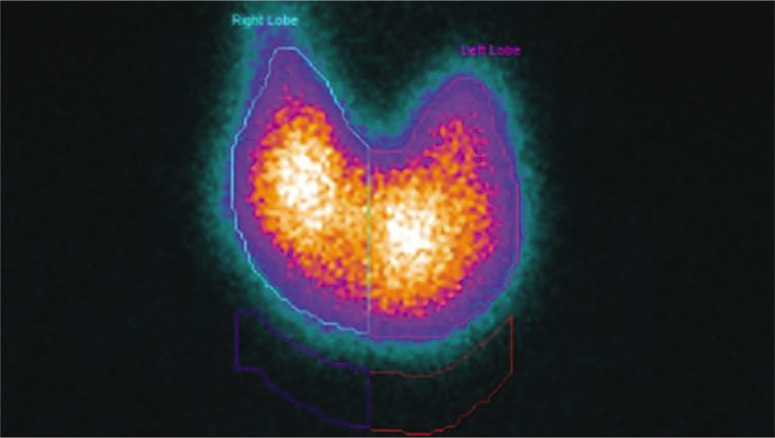 Oscillation between Hyperthyroidism and Hypothyroidism in an Adolescent Female with Graves' Disease.