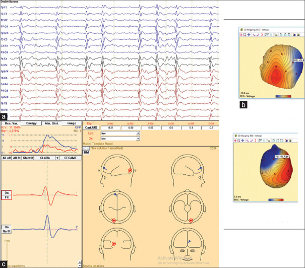 Clinical and Electrical Evolution of "Pseudo" Spike-Wave Activation in Sleep EEG Patterns in Self-Limited Childhood Epilepsies.