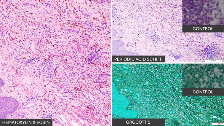 PYODERMA GANGRENOSUM WITH NON-PSEUDOMONAL ECTHYMA GANGRENOSUM IN MYELODYSPLASTIC SYNDROME TREATED WITH ALLOGENEIC HEMATOPOIETIC STEM CELL TRANSPLANTATION.