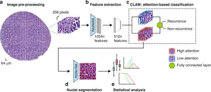 Deep learning-based interpretable prediction of recurrence of diffuse large B-cell lymphoma.
