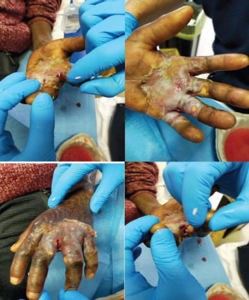 A hard-to-heal wound: a case study on the collaboration between nonprofit and Public Health Sector in Southern Italy.