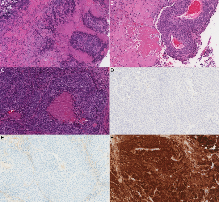 Pilomatrix-like High-grade Endometrioid Carcinoma of the Uterine Corpus With Excellent Response to Immune Checkpoint Inhibitor Therapy.