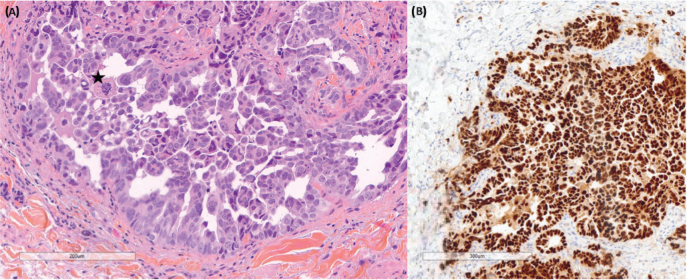 Coalescing Papules on the Pubis in an Ovarian Carcinoma: A Quiz.