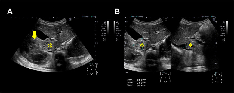 Effective management of acute hemorrhage using an SL One<sup>®</sup> rapid infusion device in a pediatric patient undergoing nephrectomy for Wilms tumor with inferior vena cava extension: a case report.
