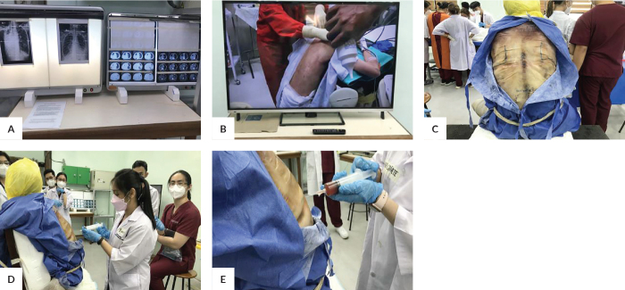 Integration of Simulated Thoracentesis Using Thiel-preserved Cadavers in the Teaching of Thoracic Anatomy for Learning Unit III Medical Students: An Innovative Learning Strategy.