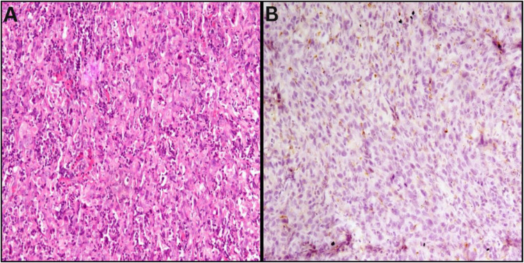 Role of Intratumoural Budding and Its Association with Tumour-Associated Macrophages in Preoperative Biopsies of Oral Squamous Cell Carcinoma.
