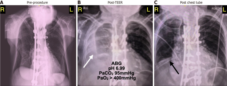 Low-pressure tamponade due to hemothorax after transcatheter edge-to-edge repair of the mitral valve.