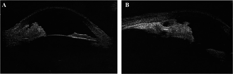 A case report: iridociliary melanocytoma associated with secondary glaucoma.