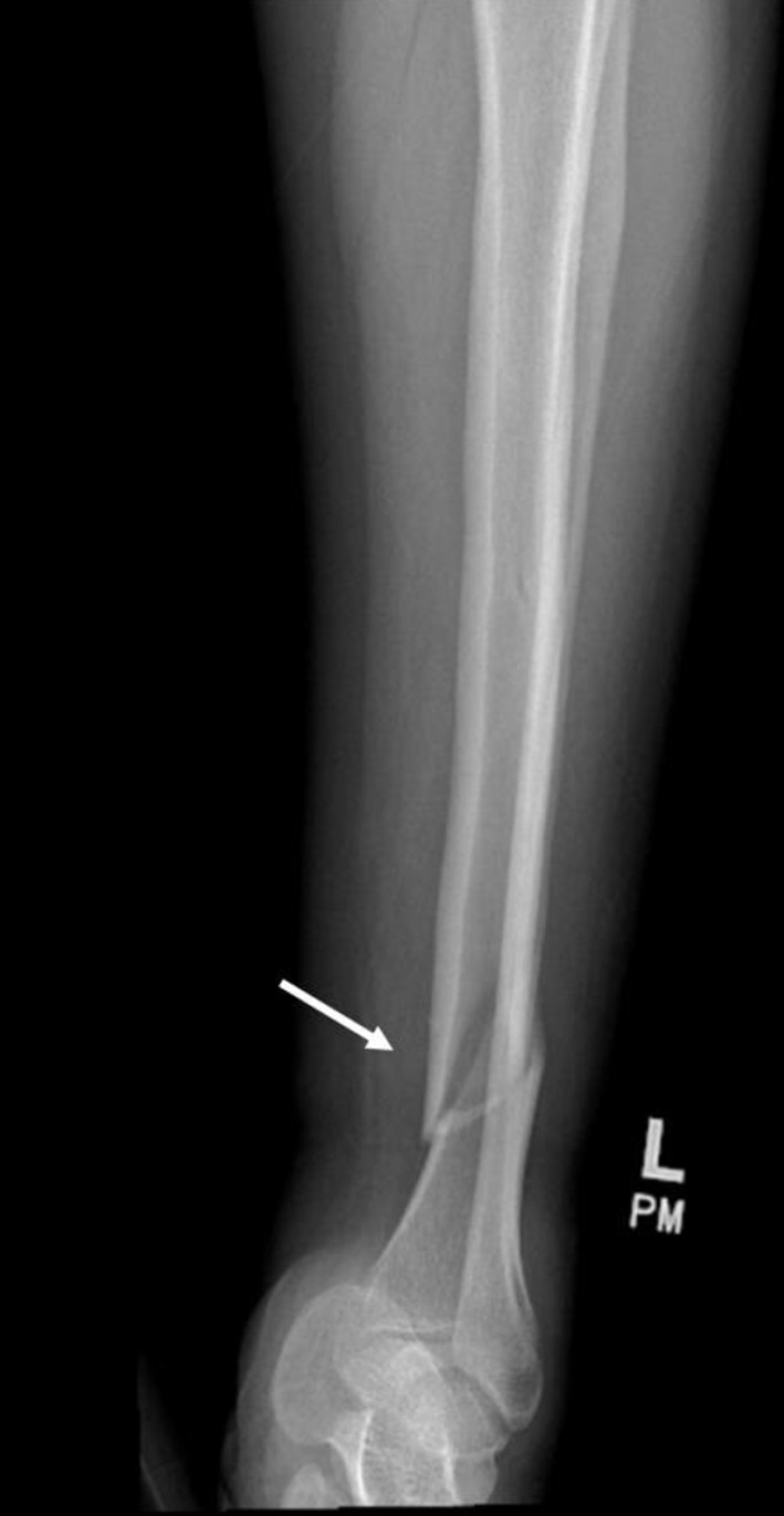 Lacosamide-Induced Complete Heart Block in a Healthy Young Female.