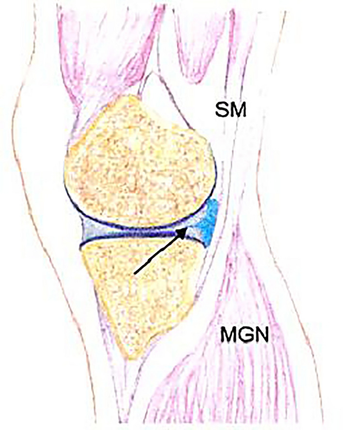 Comprehensive analysis of knee cysts: diagnosis and treatment.