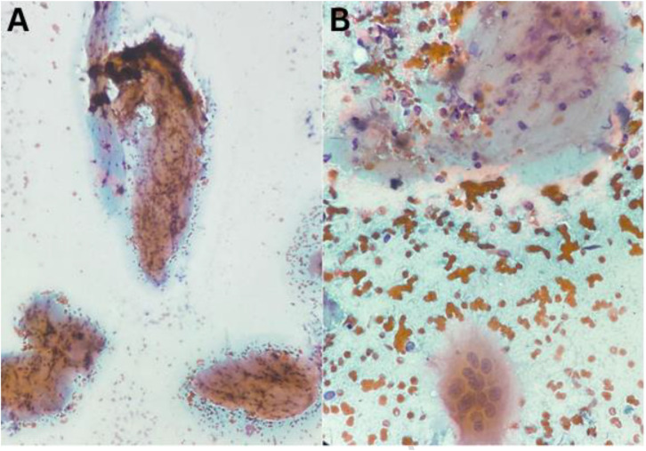 Chondromyxoid Fibroma of Phalanges.