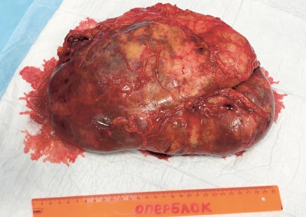 [Difficulty with differential diagnosis on adrenal lesions in congenital adrenal cortex dysfunction: a series of clinical cases].