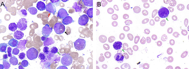 Acute Myeloid Leukemia with <i>NUP98::LNP1</i> Fusion Mimicking Chronic Myeloid Leukemia