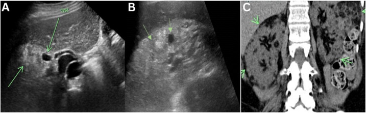 The Multifaceted Nature of Tuberous Sclerosis Complex.