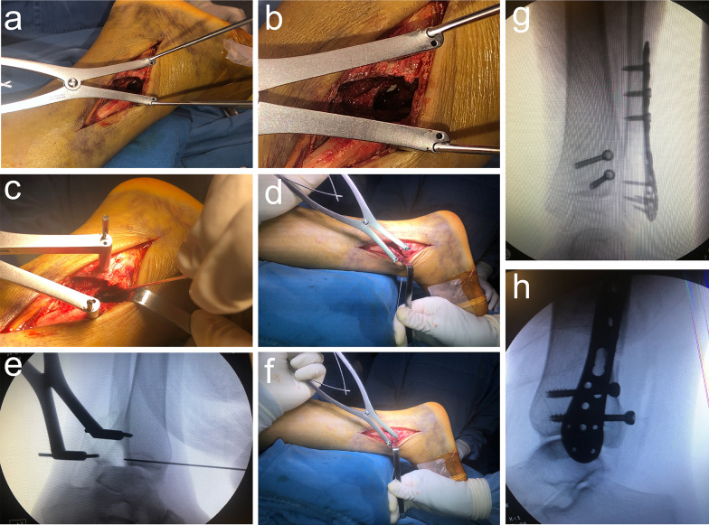 Reduction and outcome of posterior pilon fractures with intercalary fragments: a retrospective cohort study comparing the transfibular and posteromedial approaches.