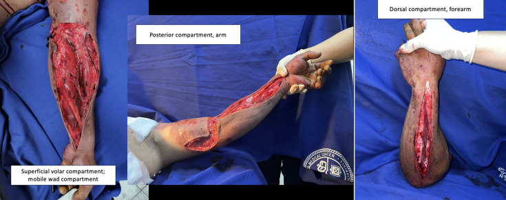 Under pressure: a case of compartment syndrome secondary to crushing injury utilizing Whitesides's apparatus.