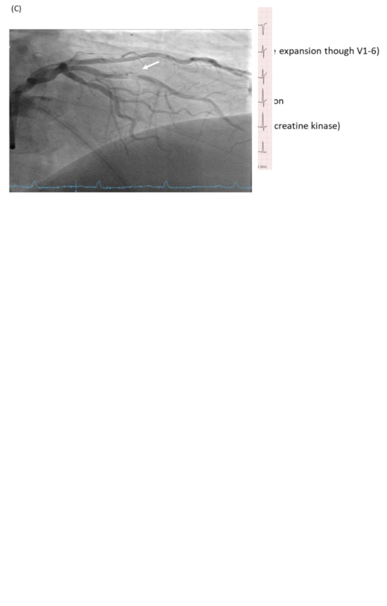 The painless ST-elevation myocardial infarction equivalent: a case report.