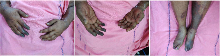 Symmetrical Peripheral Gangrene Associated with <i>Plasmodium Vivax</i> Malaria: <i>A case report with a brief review of literature</i>.