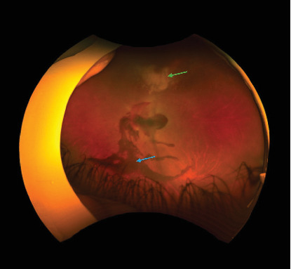 Combined Cytomegalovirus Retinitis and Vitreous Hemorrhage in an Immunocompromised Patient.
