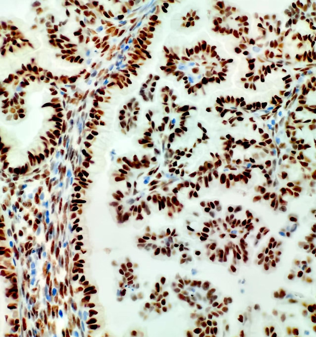 Complex papillary hyperplasia of the endometrium: an uncommon case report with cytopathological features and diagnostic implications.
