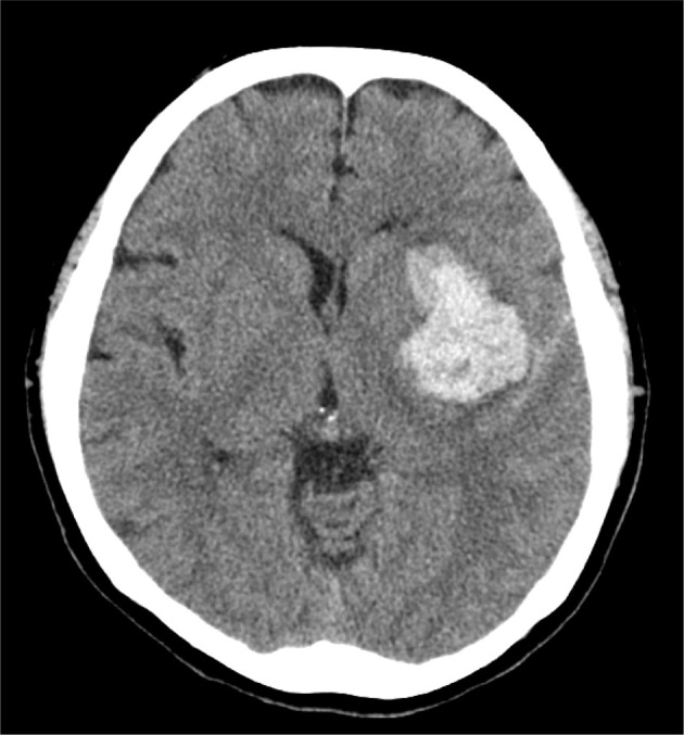Effects of body weight-supported overground training on gait recovery in severe stroke-induced hemiplegia: a single-case ABAB design.