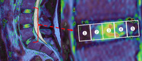 Running Acceleration Correlates With T2 Magnetic Resonance Imaging Values of the Lumber Intervertebral Disc.