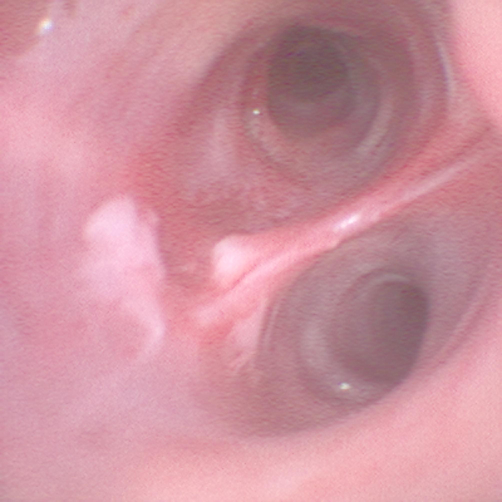 Unperceived bronchial bleeding complications during percutaneous dilatational tracheotomy: a case report and 3D simulation.