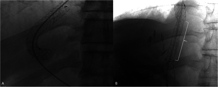 Controlled expansion stent grafts versus legacy stent grafts for transjugular intrahepatic portosystemic shunt: a single-centre retrospective study on the incidence of hepatic encephalopathy.